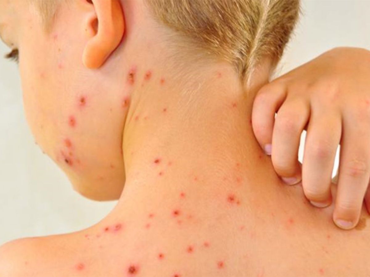 ¿Quiénes deben vacunarse contra el sarampión?